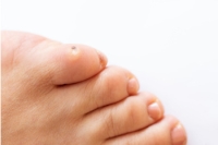 Caring for Corns on Children’s Feet