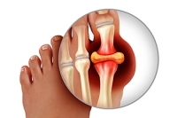 Gout Is a Metabolic Disorder